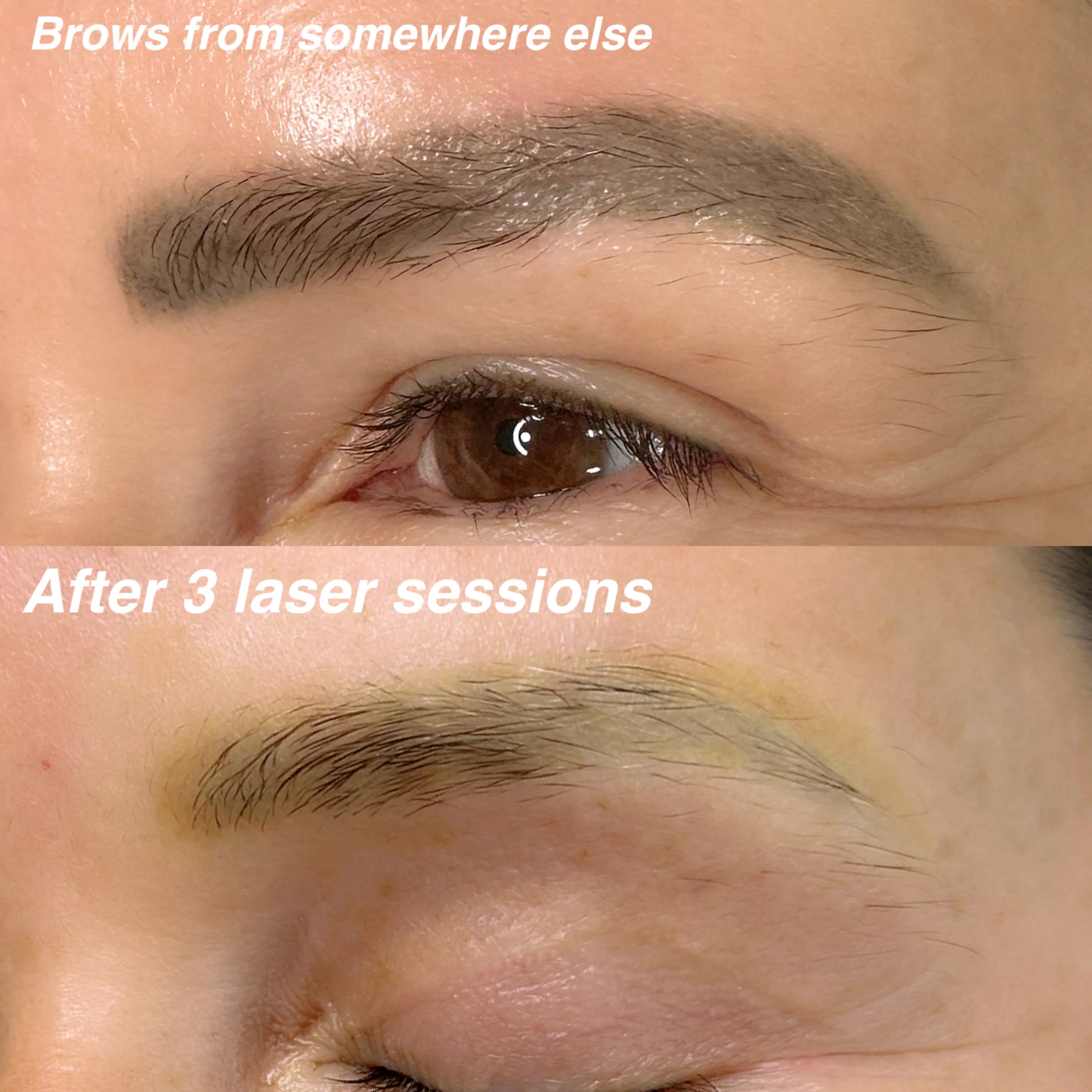 Laser Brow Tattoo Removal (Service)