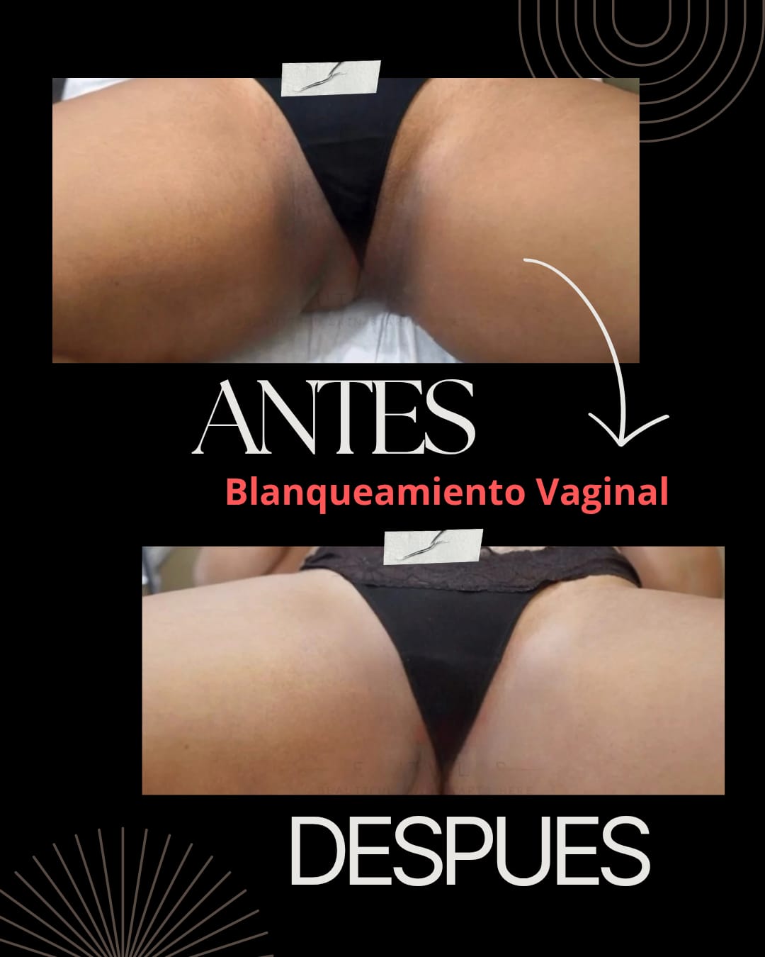 Intimate Whitening Individual (Service)
