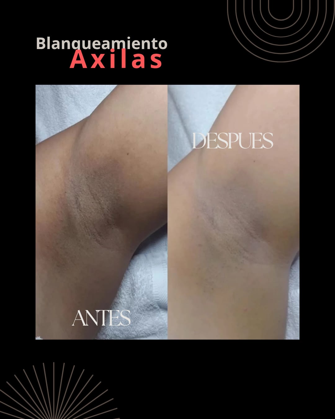 Intimate Whitening 2 sessions or 2 areas (Service)